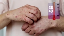 Кызылча жугузгандар көбөйдү, эпидемиологиялык абал курч   
