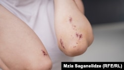დაზარალებული ქალის დაზიანებები ხელებზე