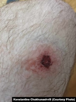 კონსტანტინე ჩახუნაშვილს რეზინის ტყვიის კვალი ხელზე და ფეხზე აღენიშნება.