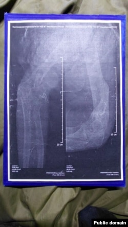 Здымкі зламанай рукі Івана Грабеньнікава