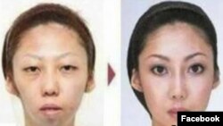 ХIусамнана, пластикан операци яле а, йинчул тIаьхьа а.