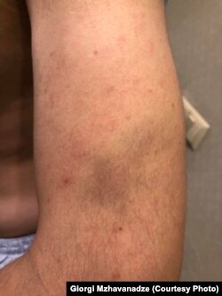 გიორგი მჟავანაძის დაზიანებები