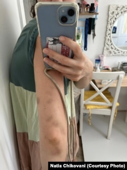 ნათია ჩიქოვანის დაზიანებული ხელი