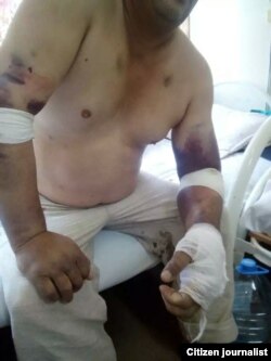 Российские врачи говорят, что для лечения узбекистанцев потребуется еще несколько месяцев.