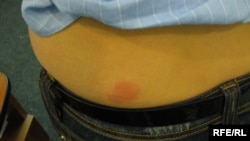 Tagtabitiň dişlän ýeri (illýustrasiýa suraty)