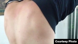 Следы от побоев на теле одного из обвиняемых.
