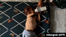 سوتغذیه کودکان
