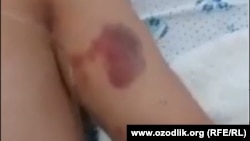 Телесные повреждения на теле жителя Андижана А. Абдукаримова. Кадр из видеозаписи.
